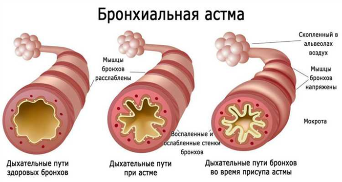 Как определить степень тяжести астмы перед призывом