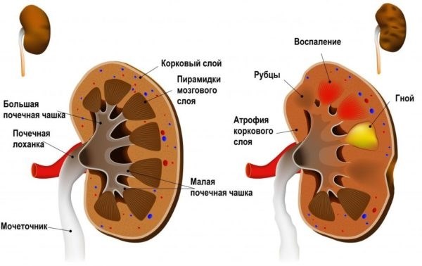 Пиелонефрит: что это такое?